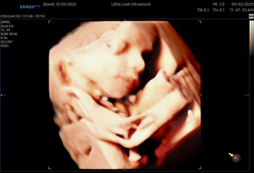 3d ultrasound baby