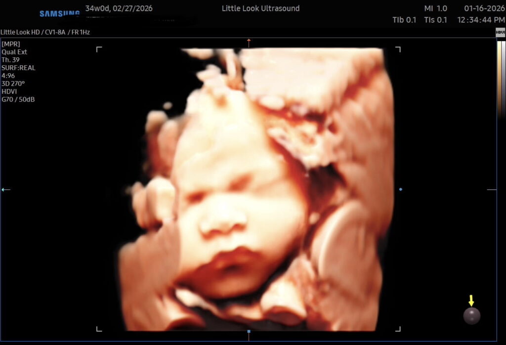 3d 4d ultrasound final third trimester scan